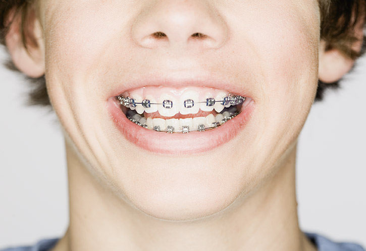 Braces Braces