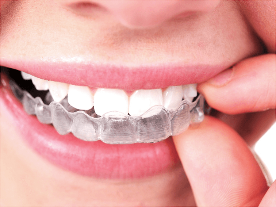 What is Invisalign and what are the benefits?