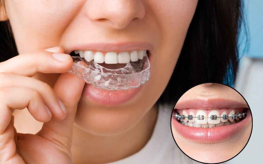 Braces vs. Clear Aligners: Which Is Right for You?