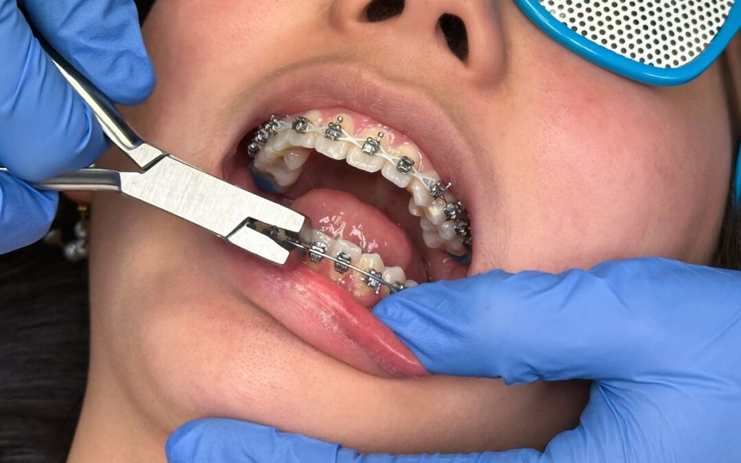 How Long Do Braces Hurt? A Complete Pain Guide Week by Week