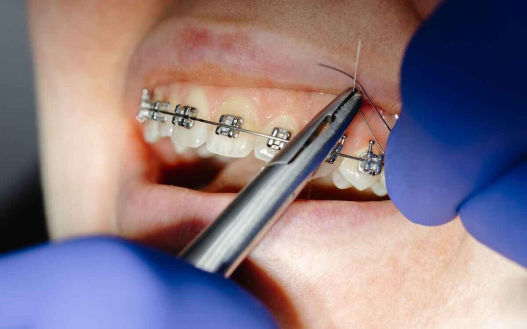 What to Do for a Broken Bracket or Wire in Austin