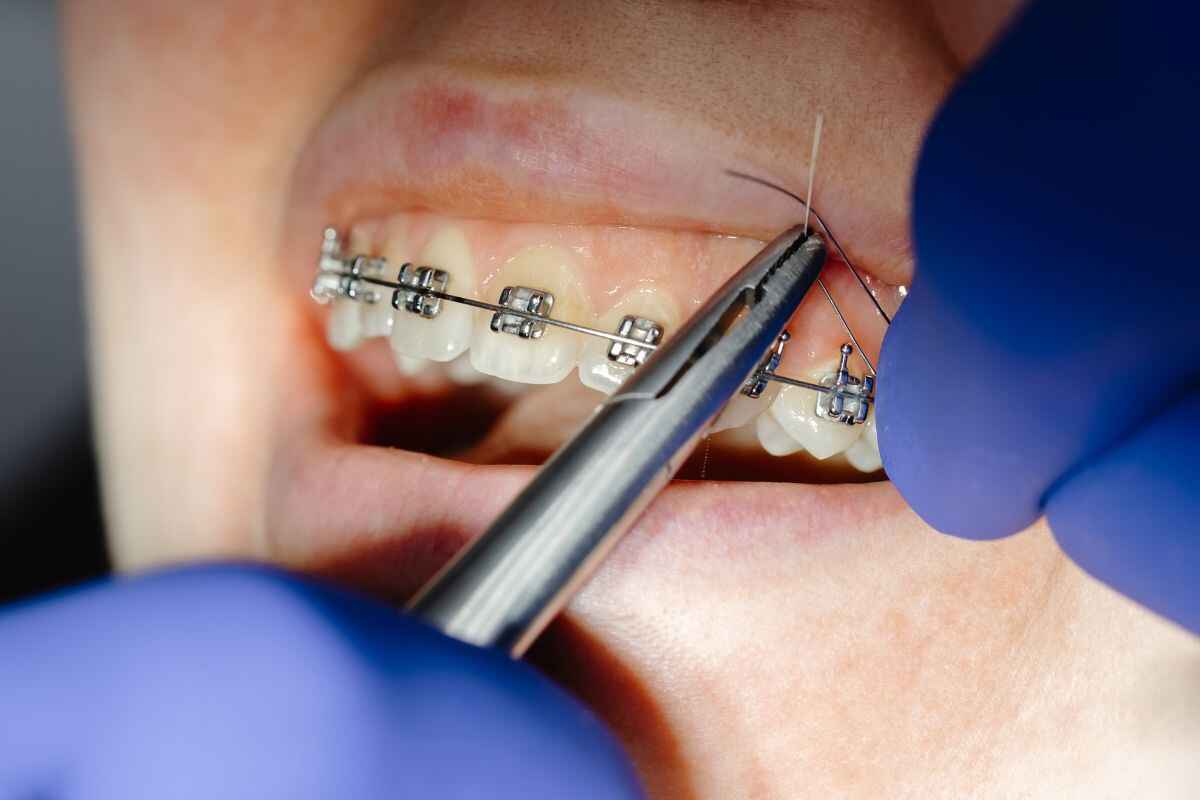 orthodontic braces adjustment procedure Close-up of an orthodontist using dental pliers to adjust the archwire on a patient's metal braces