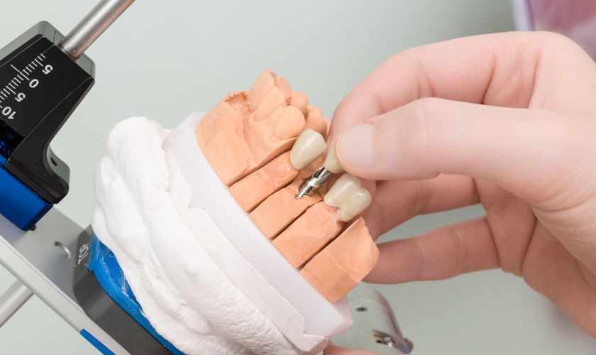 Dental Implant in Austin Dental Implant in Austin