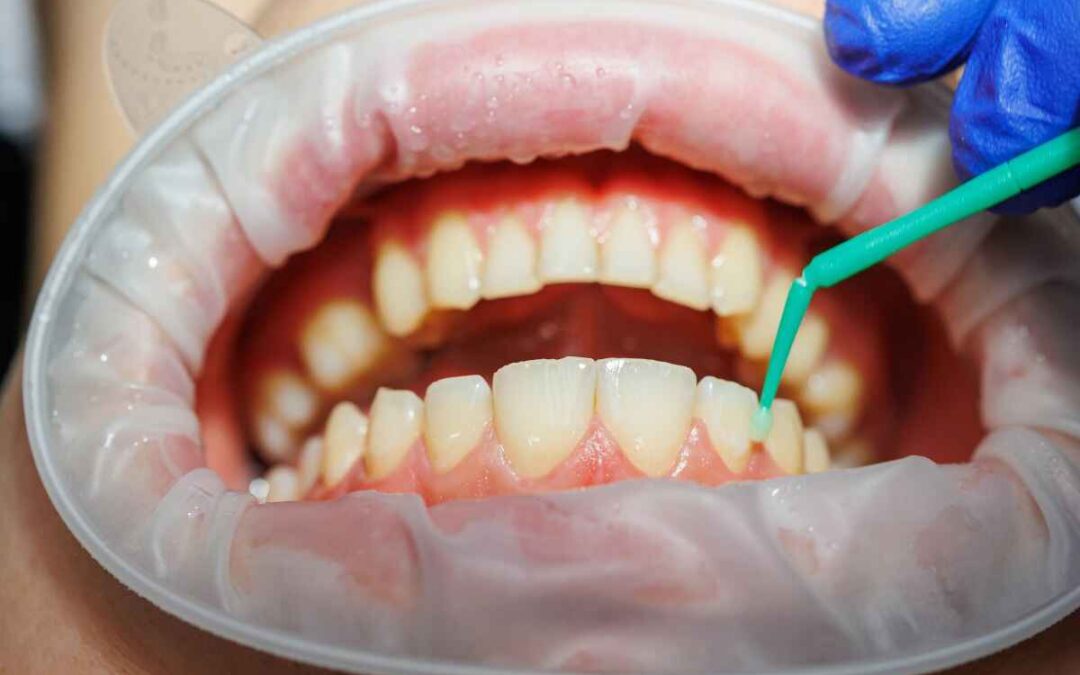 Gum Disease Awareness Month: How Texas Can Protect Their Gums