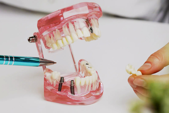 img-dental-implant-5th-strt