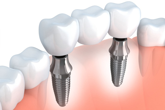 img-dental-implant-riverside
