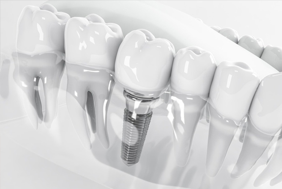 img-dental-implant