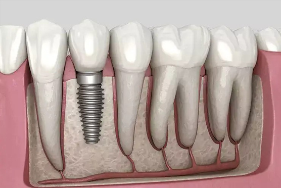 img-oak-forest-dental-implant