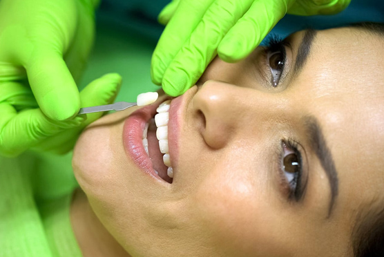 img-veneers