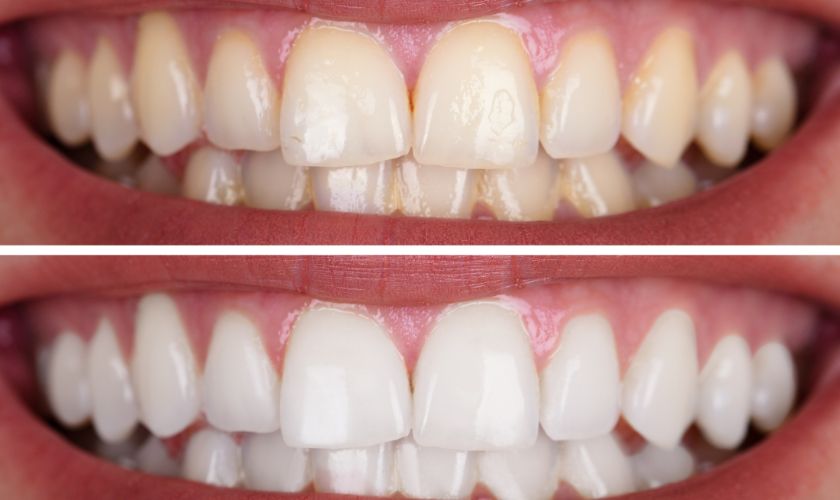 Teeth Whitening Houston, TX – BLVD Dentistry Teeth Whitening Houston, TX - BLVD Dentistry & Orthodontics Galleria