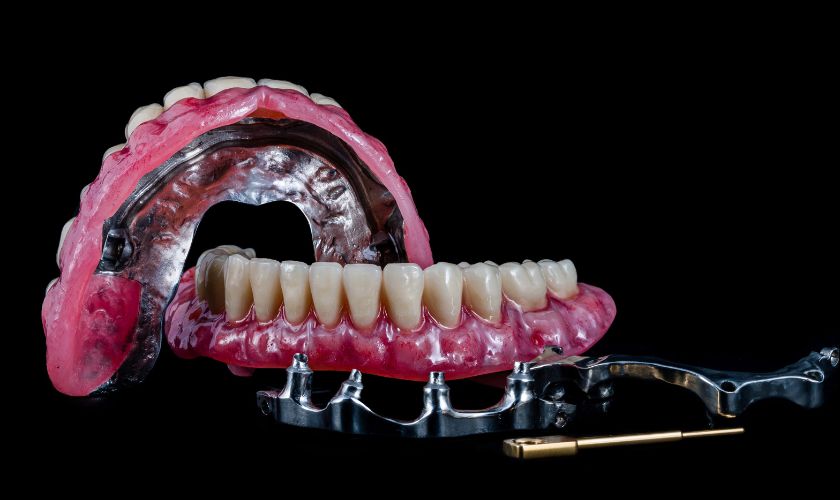 All-on-4 Implants Houston TX – BLVD Dentistry All-on-4 Implants Houston TX - BLVD Dentistry