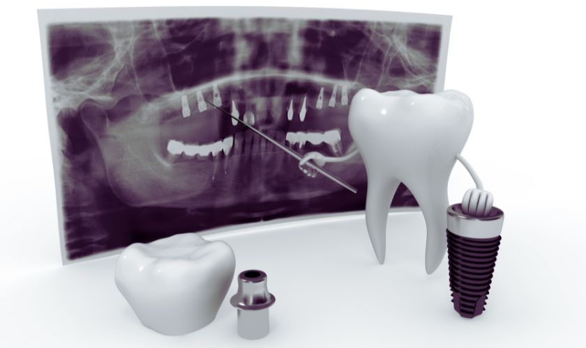 Dental Implants Tx – BLVD Dentistry Dental Implants Tx - BLVD Dentistry