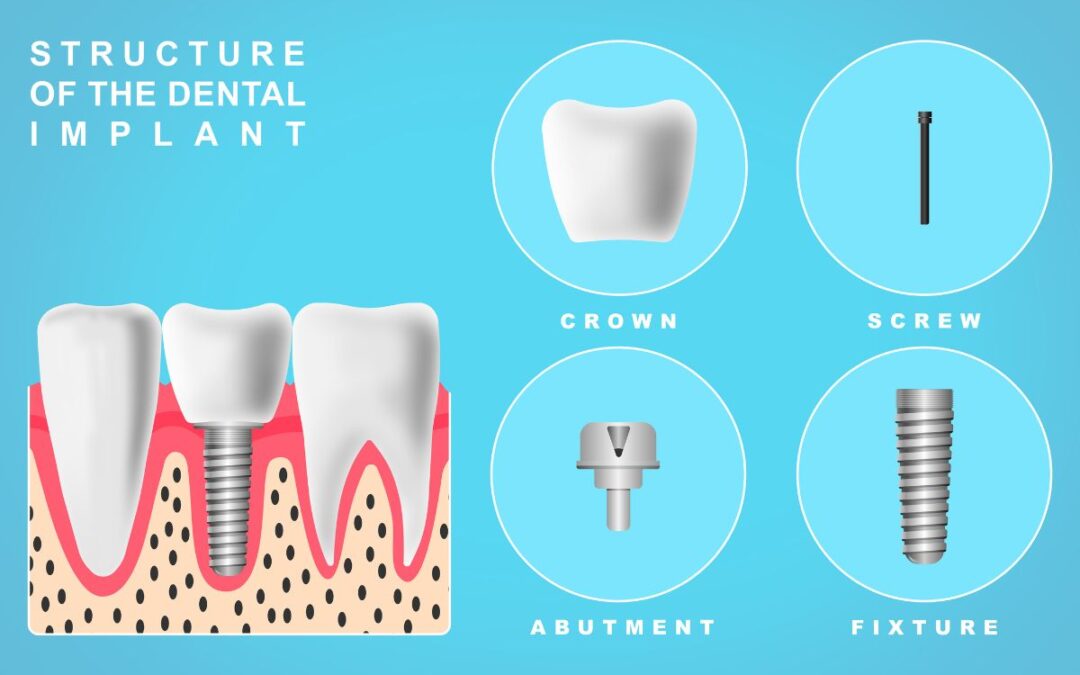 Worried About Dental Implant Pain? Experts Explain the Procedure