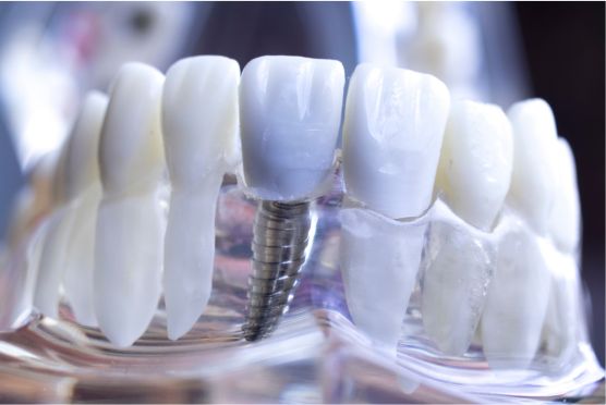 Dental Implants Austin TX - BLVD Dentistry Dental Implants Austin TX - BLVD Dentistry