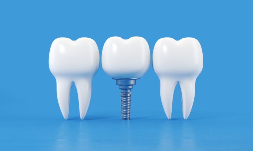 dental-implants-houston-tx dental implants houston