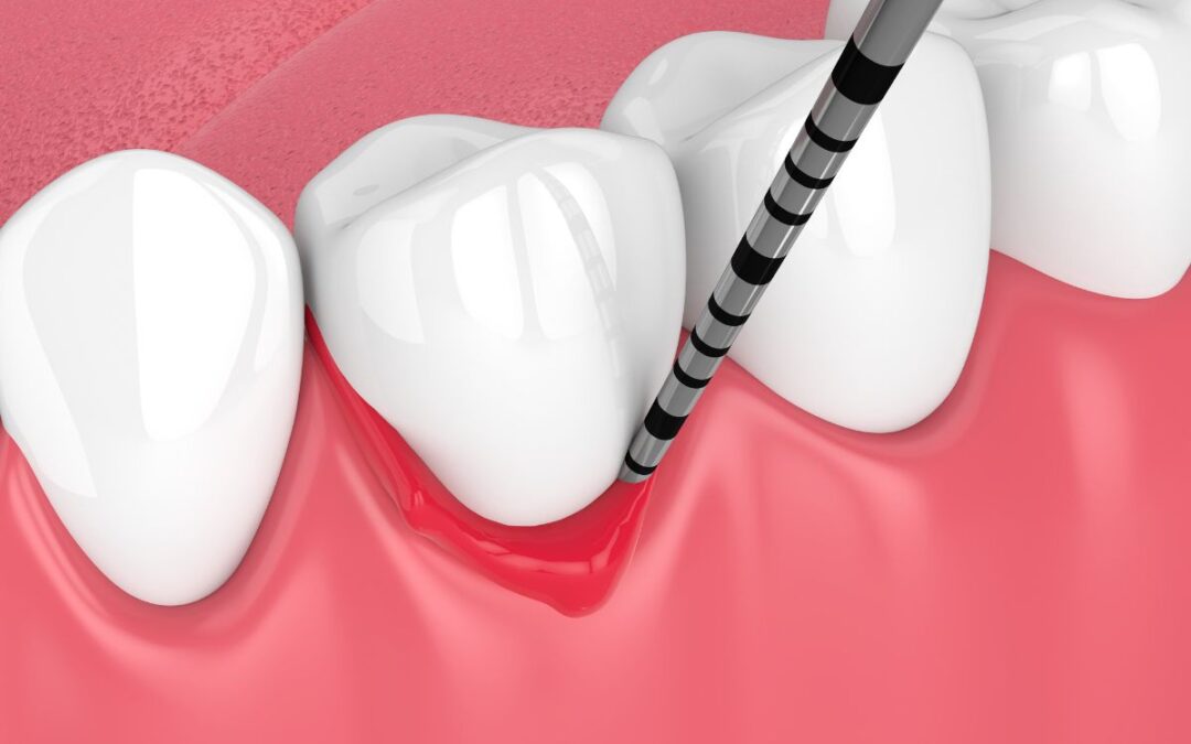 Gum Disease: Don’t Let It Steal Your Smile