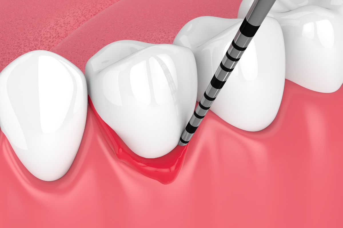 Gum Disease – Dentist in Austin, NV – BLVD Dentistry Gum Disease - Dentist in Austin, NV - BLVD Dentistry