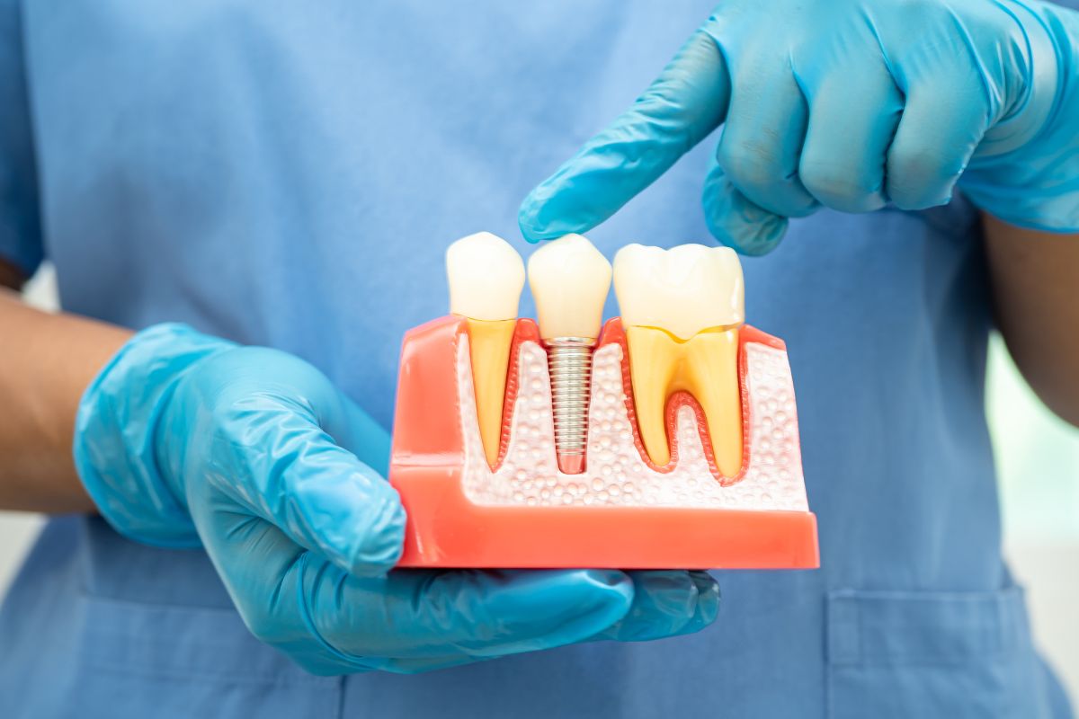 dental implants dental implants