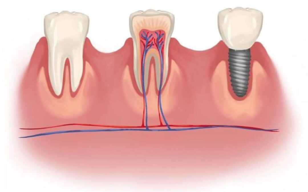 Implant Infection: How to Avoid Complications and Ensure a Successful Procedure