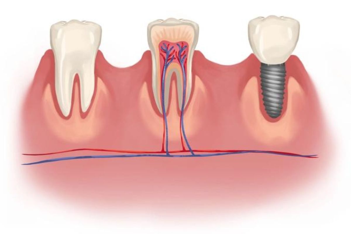 Dental Implants Austin TX at BLVD Dentistry Dental Implants Austin TX at BLVD Dentistry & Orthodontics