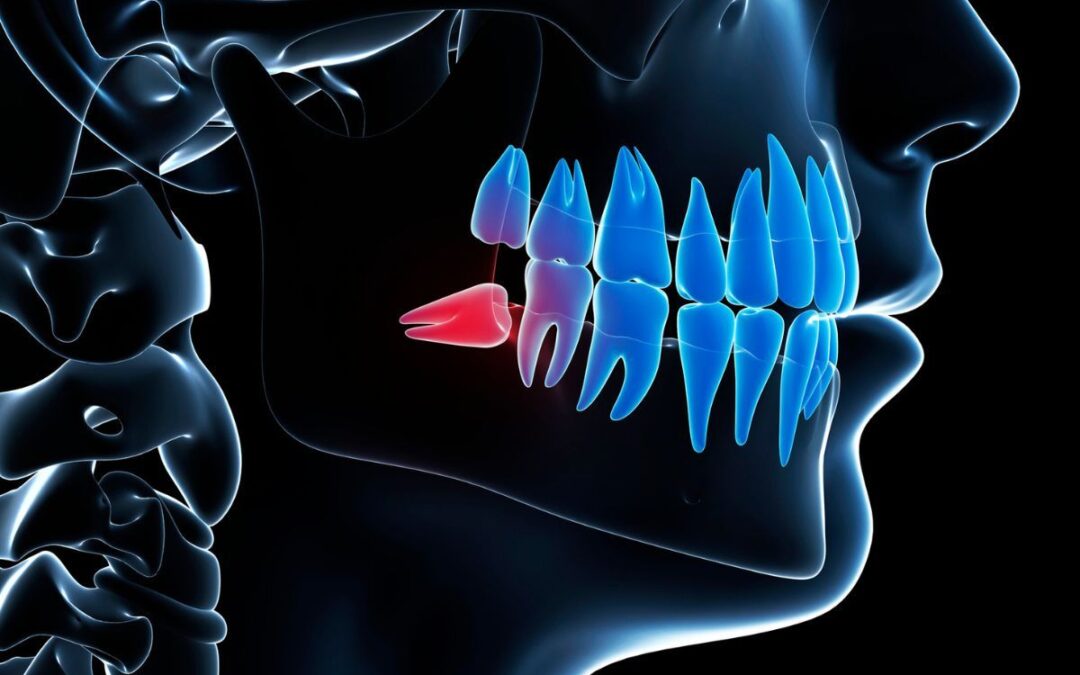 Wisdom Teeth and Orthodontics: How They Can Interfere with Your Smile