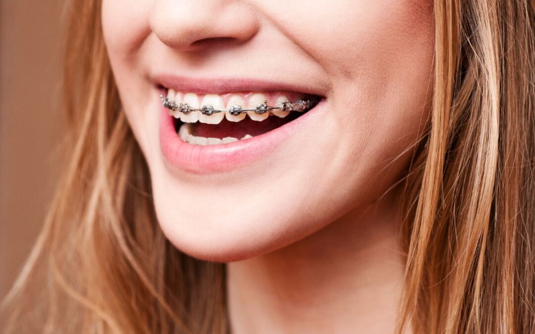 Guide to Preventing Teeth Grinding with Braces