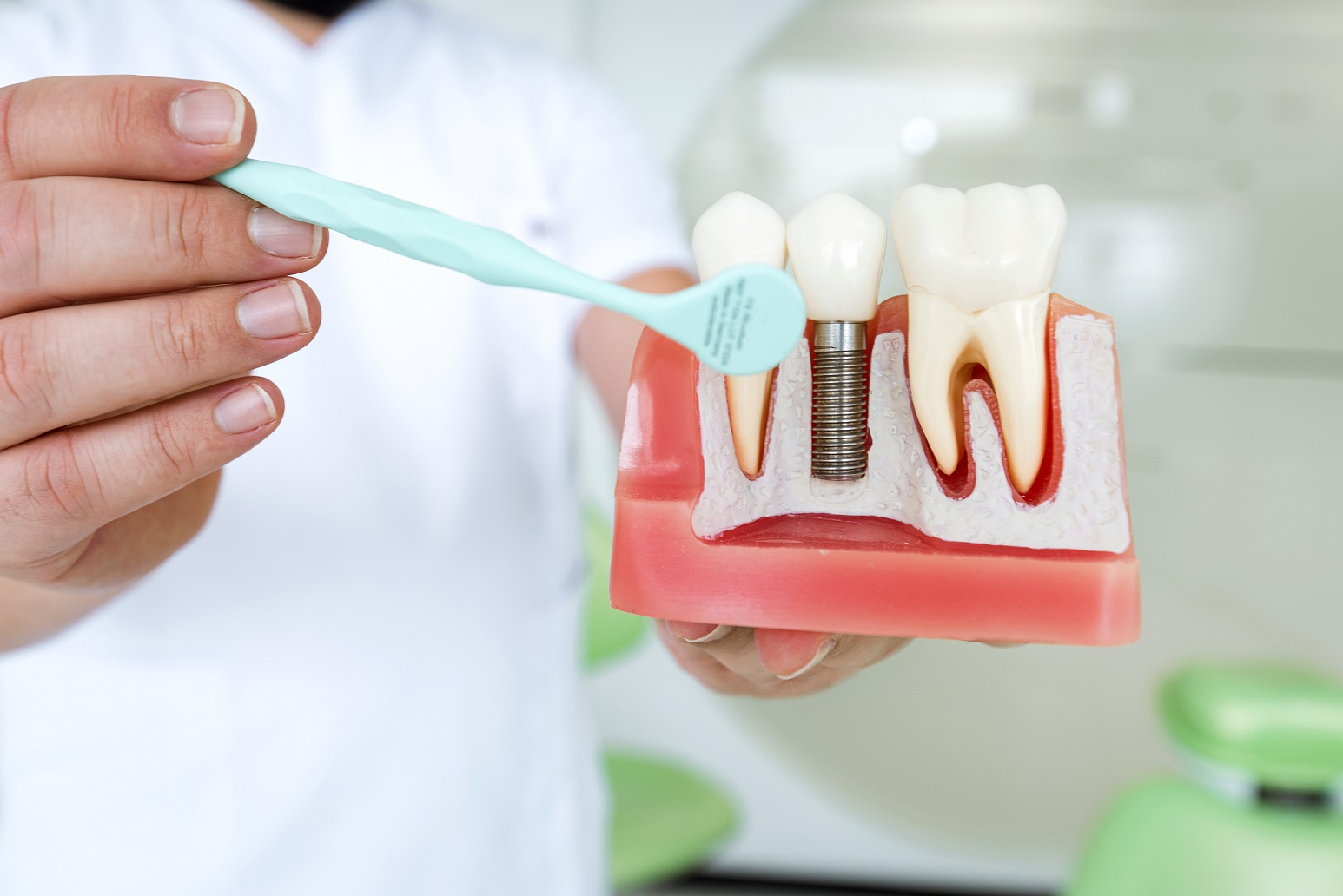 Dental Implants image