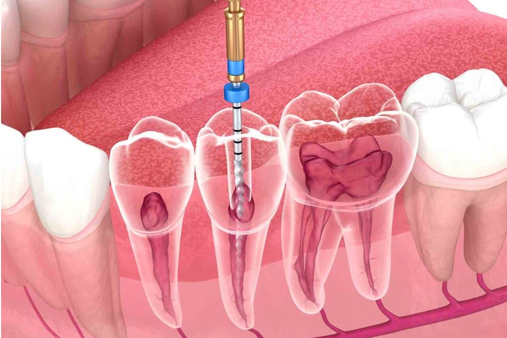 Endodontics image