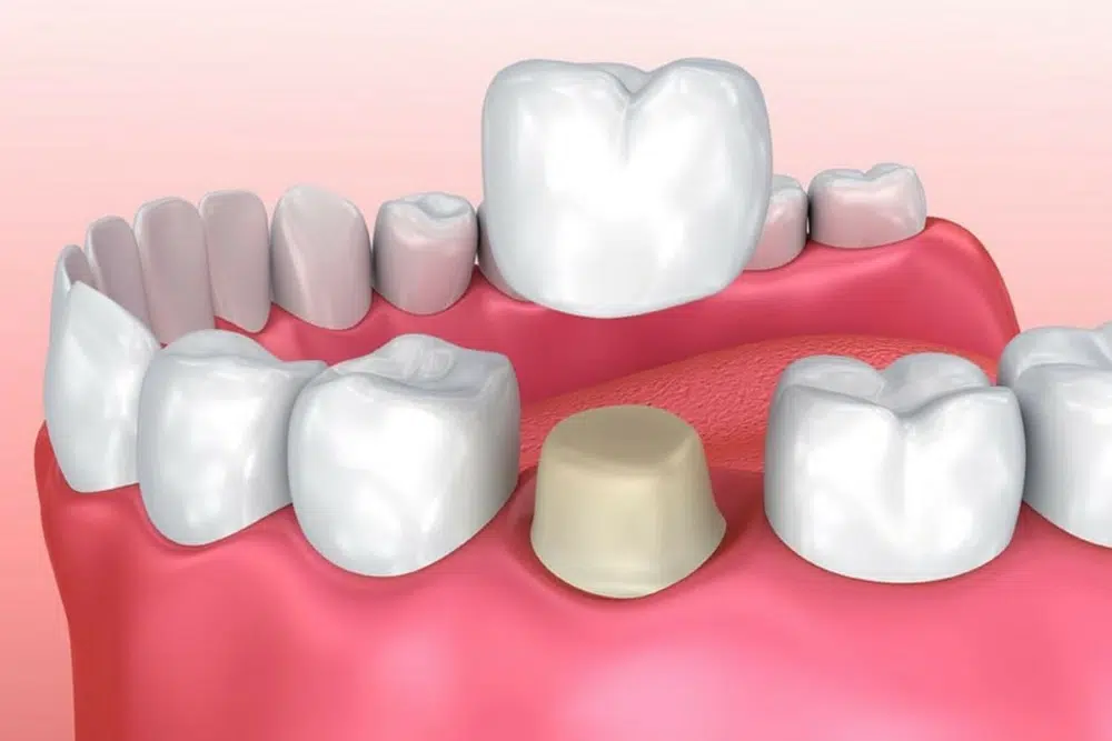 img-no-matter-if-your-teeth-are-damaged