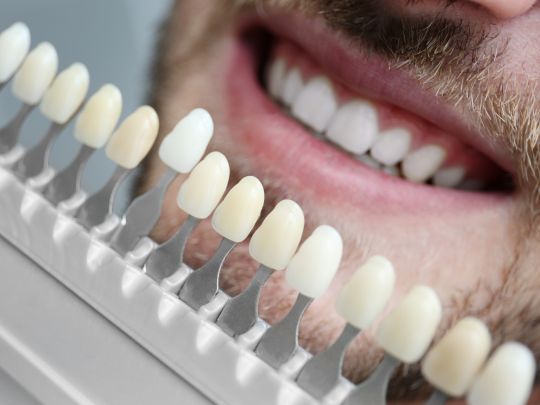 veneers fort worth veneers fort worth
