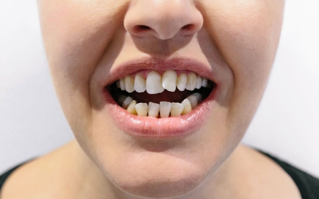 When Crooked Teeth Cause More Than Just a Confidence Issue