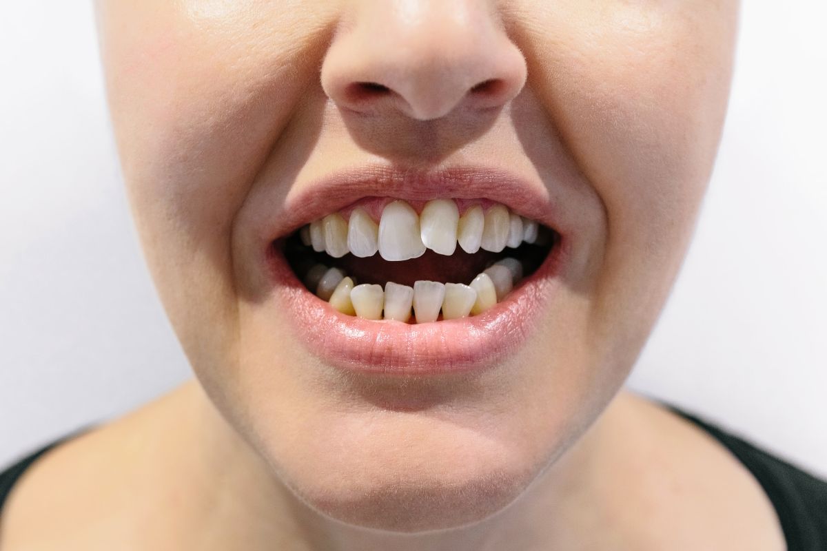 crooked tooth example crooked tooth example