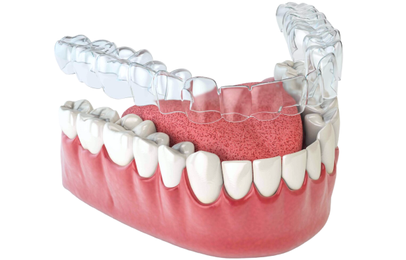 Clear Aligner