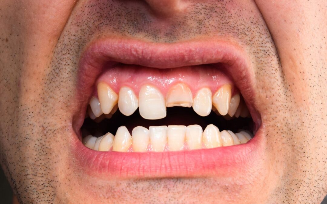 How to Handle a Broken Tooth While Enjoying Fort Worth