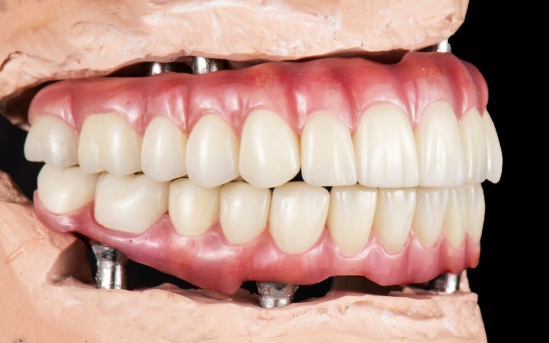 Is Your Dental Implant Infected?
