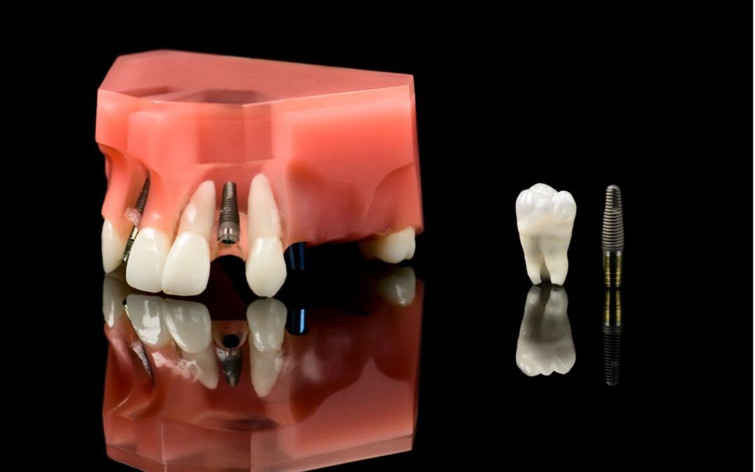 Worried About Dental Implants and Autoimmune Disease? Let’s Talk