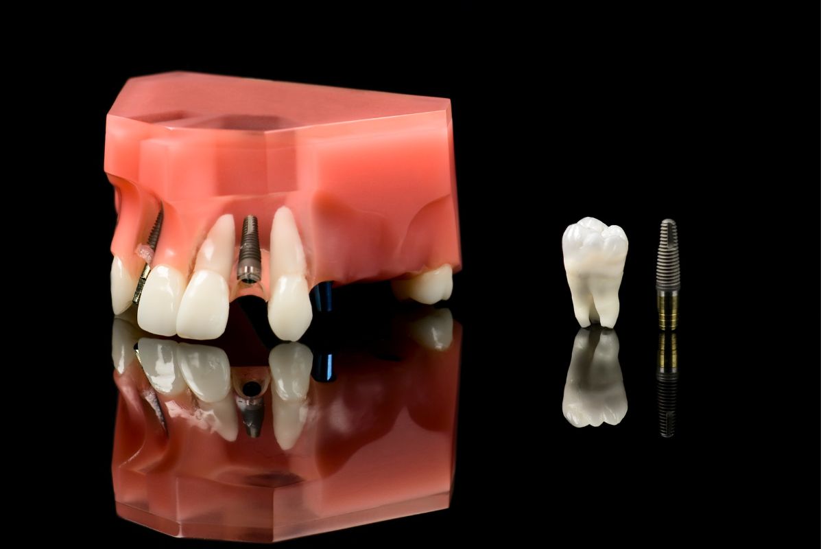 Dental Implants Houston TX at BLVD Dentistry Dental Implants Houston TX at BLVD Dentistry