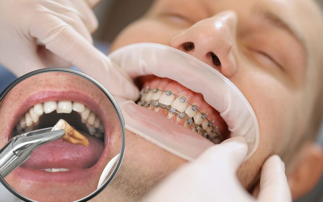 Why Tooth Extraction May Be Required To Achieve A Straighter Smile