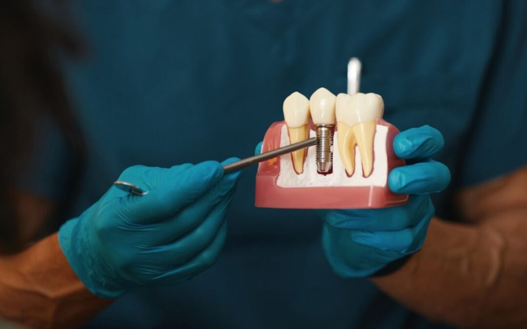 Best Ways to Maintain Your Dental Implants