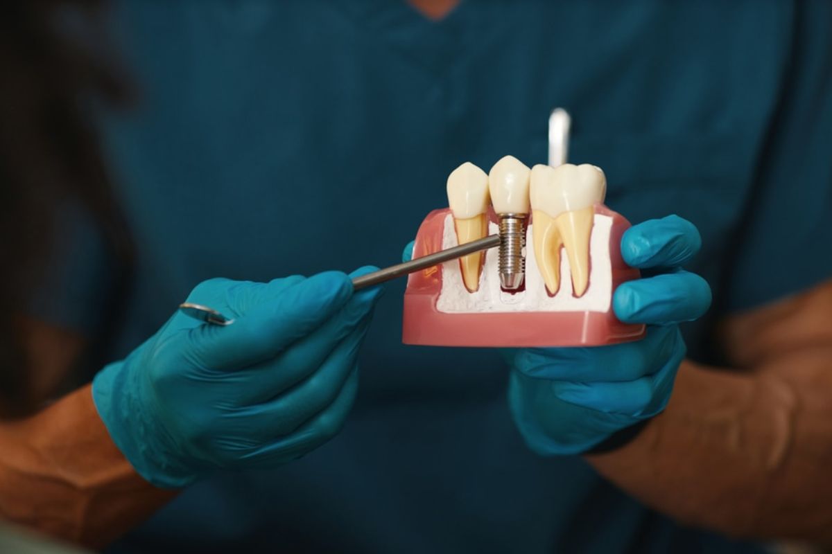dental implants care dental implants care