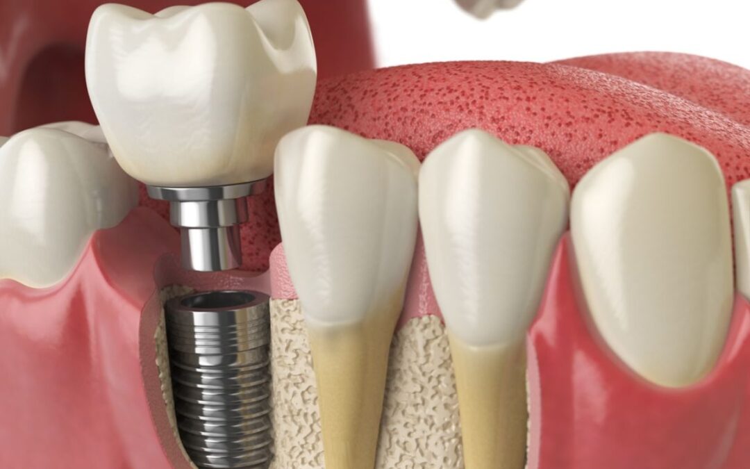 Does Dental Implant Cause Problems After Surgery?