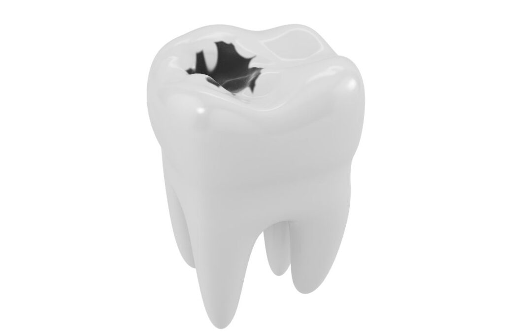What Causes Black Teeth in Adults?