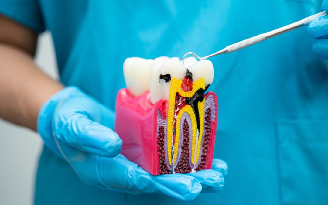 Worried About Crown Infection? Spot Problems Early