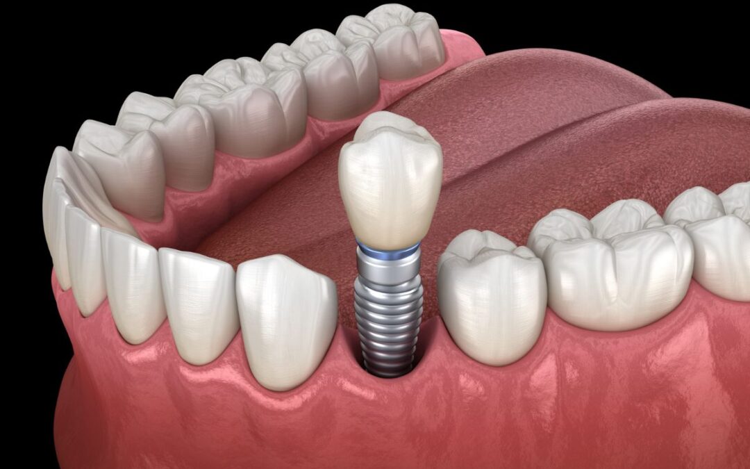 When Should You Get Dental Implants After Losing a Tooth?