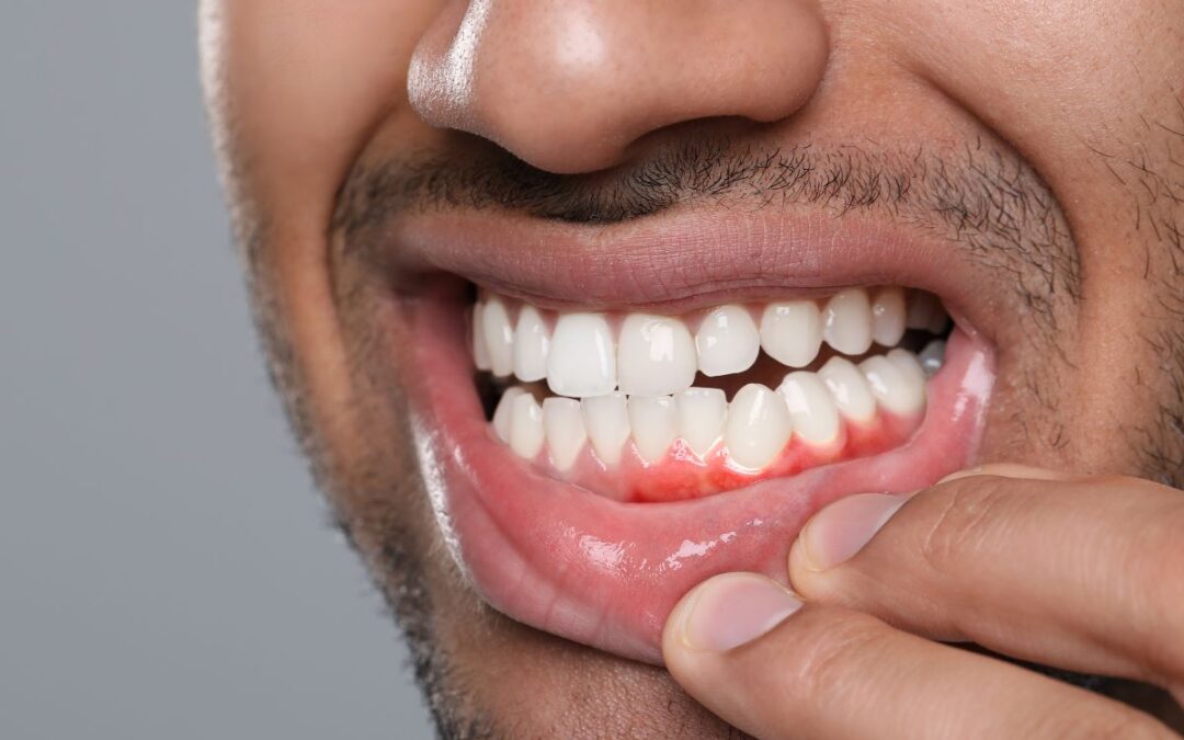 How to Spot Signs Of Gum Disease – Symptoms You Shouldn’t Ignore