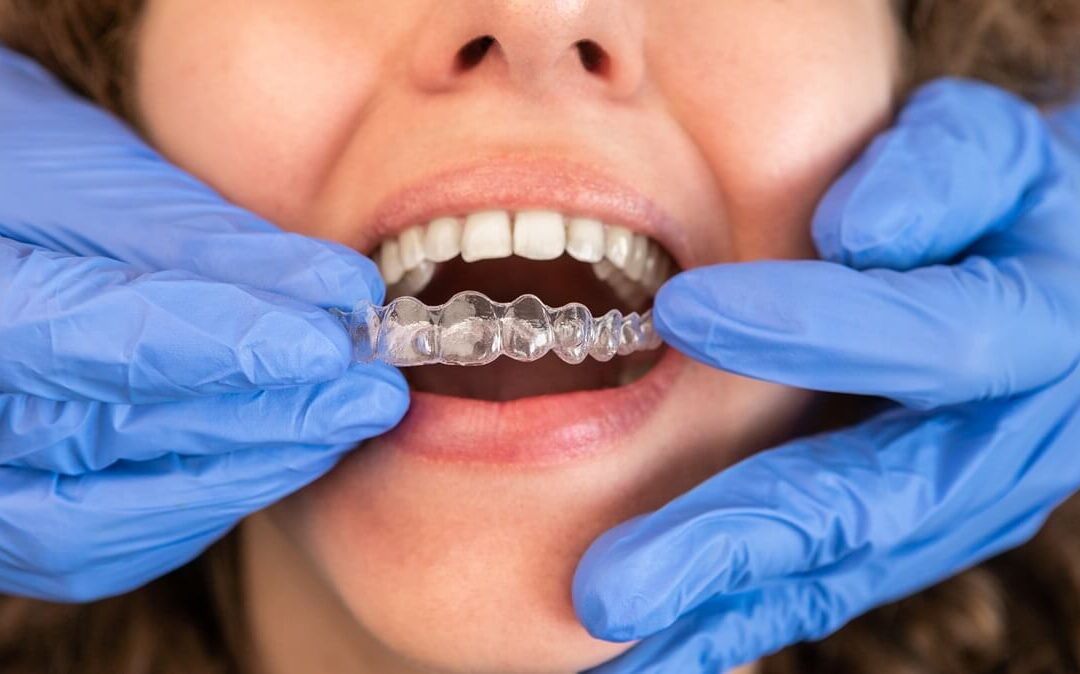 Can Invisalign Fix Bite Problems After Dental Injury?