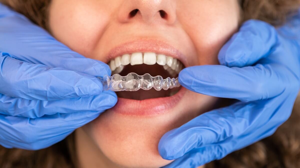 dentist placing invisalign in upper jaw of woman above 40