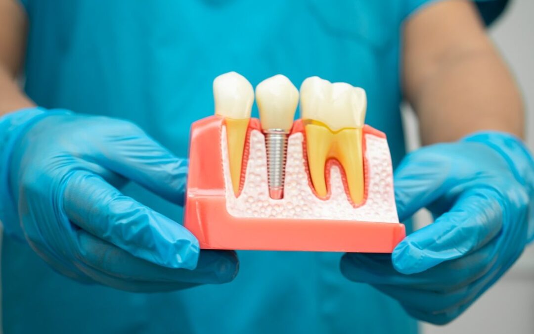 Getting Dental Implants Years After Tooth Loss? What You Need to Know