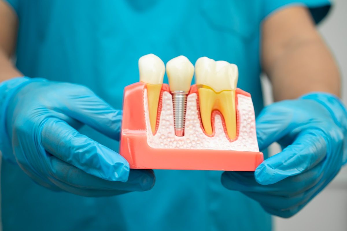 gum structure with implant dentist holding model gum structure with an implant placed