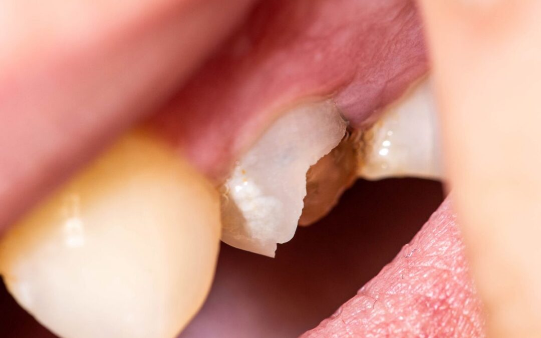How Dentists Rescue Damaged Enamel